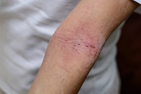 example of eczema flare-up